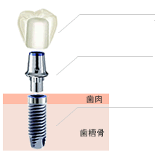 インプラント