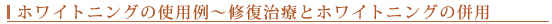 ホワイトニングの使用例~修復治療とホワイトニングの併用